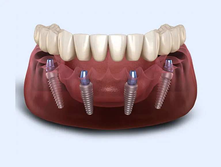 All-On-4® Technique