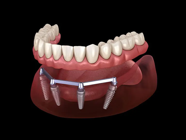 Benefits of All-On-4