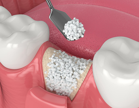 Bone Grafting Explained