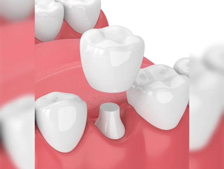 Dental Crown Lengthening Procedure