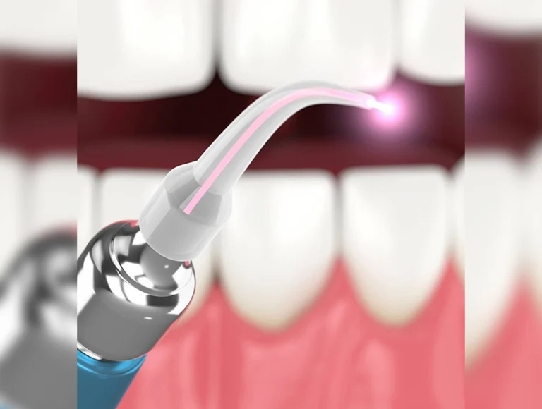 Laser Treatment for Gum Disease