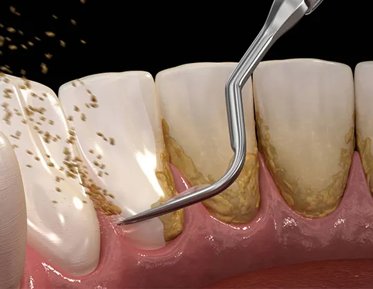 Scaling and Root Planing