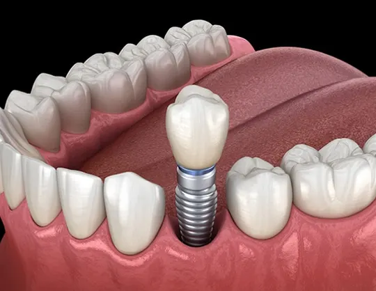 Replacing a Single Tooth