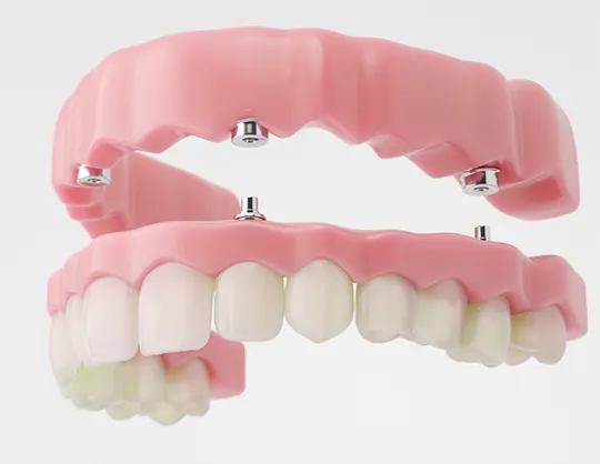 Replacing All Your Teeth